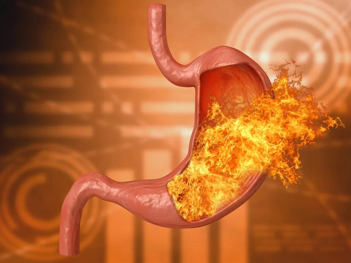 8 Home And Natural Remedies for Ulcer Ailments, 8 Home And Natural Remedies for Ulcer Ailments, ATLANTIC NET 8 Home And Natural Remedies for Ulcer Ailments, 8 Home And Natural Remedies for Ulcer Ailments