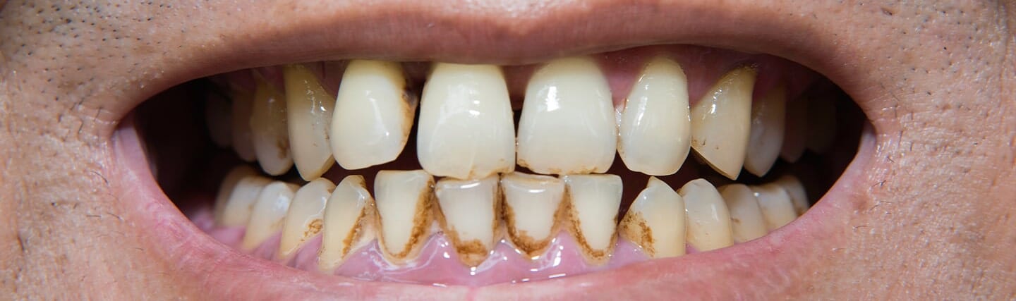4 Home Remedies For Removing Stubborn Plagues From Your Teeth, 4 Home Remedies For Removing Stubborn Plagues From Your Teeth, ATLANTIC NET 4 Home Remedies For Removing Stubborn Plagues From Your Teeth, 4 Home Remedies For Removing Stubborn Plagues From Your Teeth