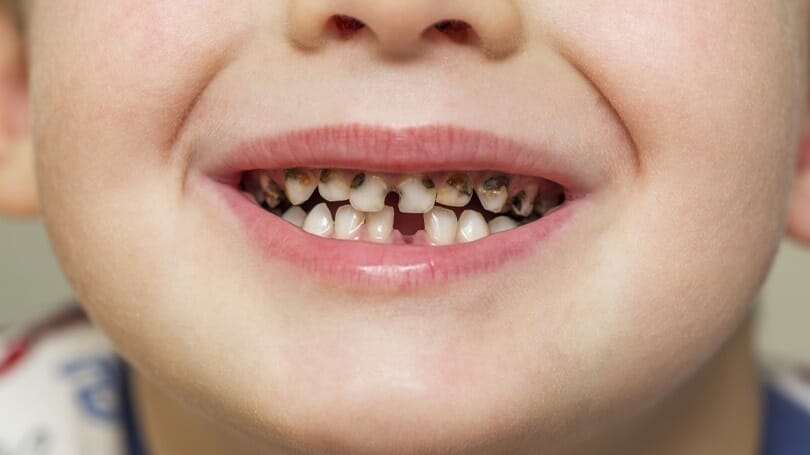 12 Powerful Home Remedies For Tooth Cavities, Dental Caries Or Tooth Decay, 12 Powerful Home Remedies For Tooth Cavities, Dental Caries Or Tooth Decay, ATLANTIC NET 12 Powerful Home Remedies For Tooth Cavities, Dental Caries Or Tooth Decay, 12 Powerful Home Remedies For Tooth Cavities, Dental Caries Or Tooth Decay